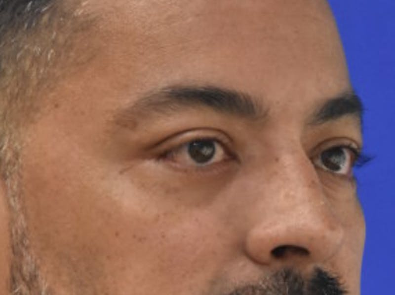 Blepharoplasty Before & After Gallery - Patient 340548 - Image 8