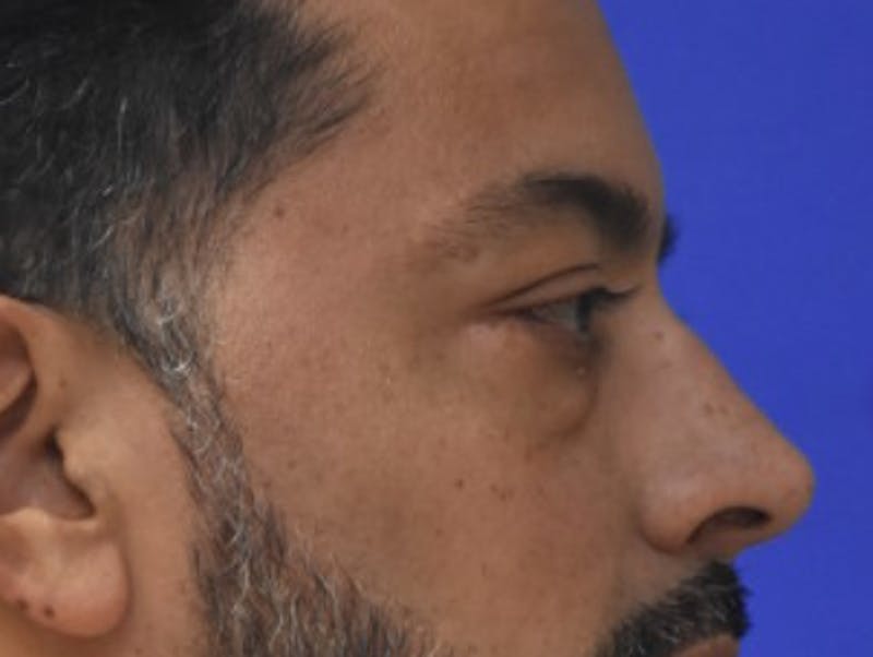 Blepharoplasty Before & After Gallery - Patient 340548 - Image 9