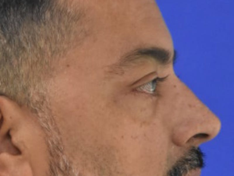 Blepharoplasty Before & After Gallery - Patient 340548 - Image 10