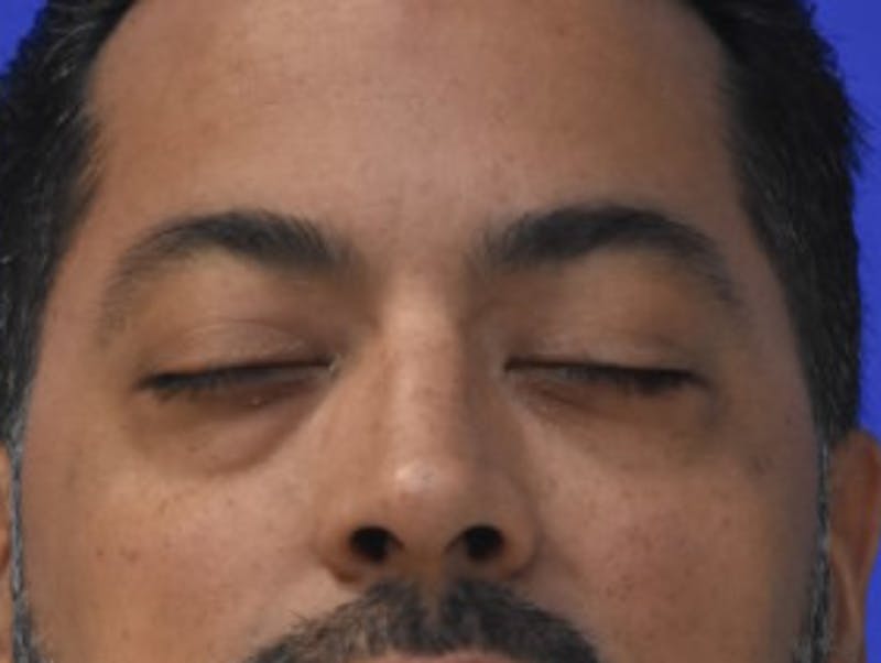 Blepharoplasty Before & After Gallery - Patient 340548 - Image 11