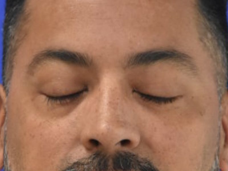Blepharoplasty Before & After Gallery - Patient 340548 - Image 12