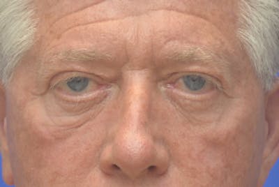 Blepharoplasty Before & After Gallery - Patient 362097 - Image 1