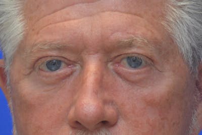 Blepharoplasty Before & After Gallery - Patient 362097 - Image 2