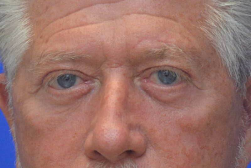 Blepharoplasty Before & After Gallery - Patient 362097 - Image 2