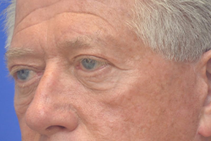 Blepharoplasty Before & After Gallery - Patient 362097 - Image 3