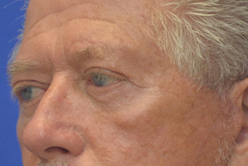 Blepharoplasty Before & After Gallery - Patient 362097 - Image 4