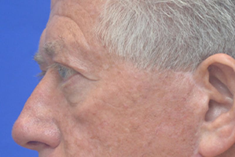 Blepharoplasty Before & After Gallery - Patient 362097 - Image 5