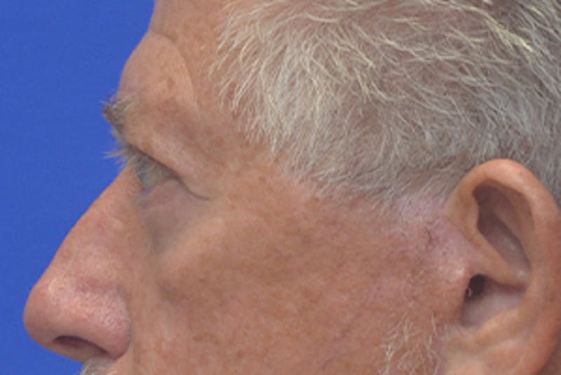 Blepharoplasty Before & After Gallery - Patient 362097 - Image 6