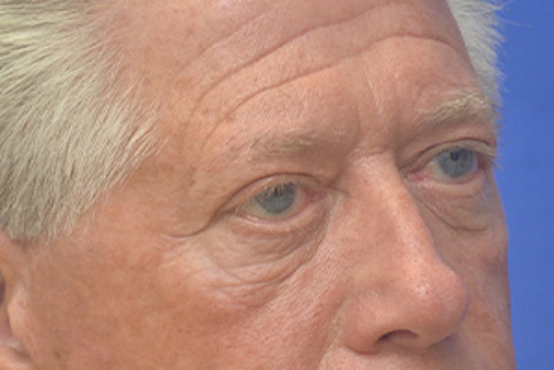 Blepharoplasty Before & After Gallery - Patient 362097 - Image 7