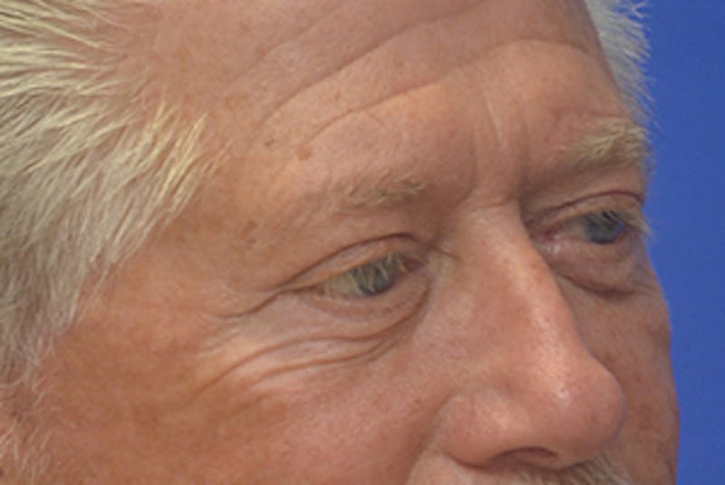 Blepharoplasty Before & After Gallery - Patient 362097 - Image 8