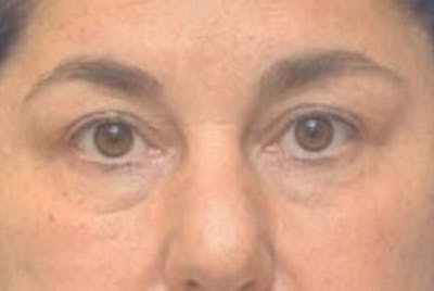 Blepharoplasty Before & After Gallery - Patient 128736 - Image 1