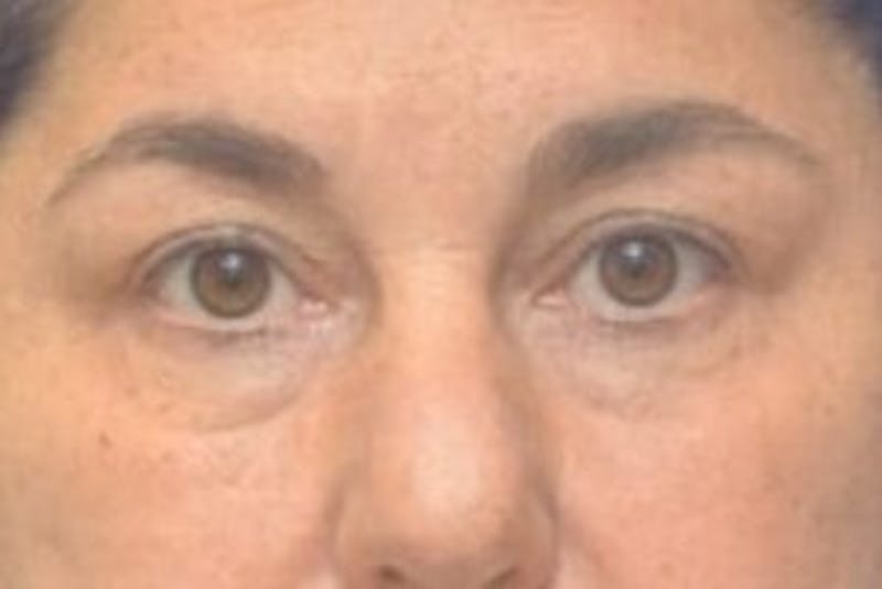 Blepharoplasty Before & After Gallery - Patient 128736 - Image 1