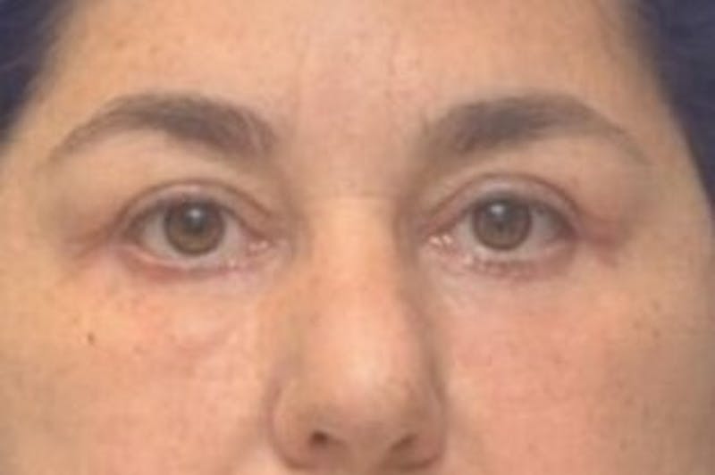 Blepharoplasty Before & After Gallery - Patient 128736 - Image 2