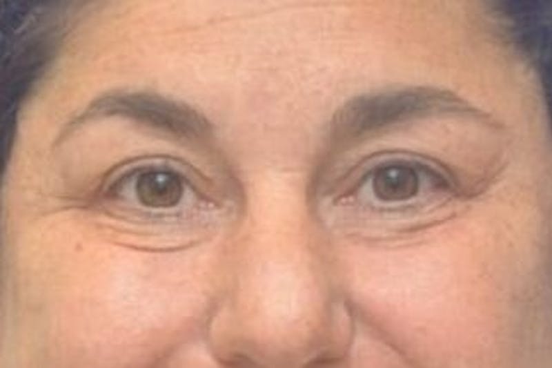 Blepharoplasty Before & After Gallery - Patient 128736 - Image 3