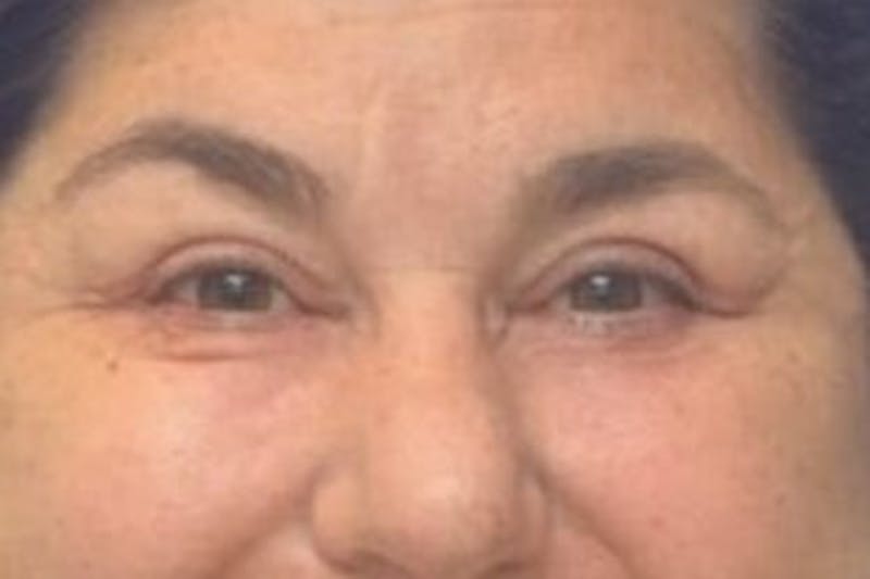 Blepharoplasty Before & After Gallery - Patient 128736 - Image 4