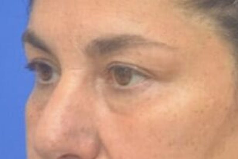 Blepharoplasty Before & After Gallery - Patient 128736 - Image 5