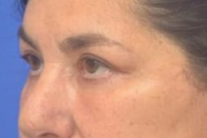 Blepharoplasty Before & After Gallery - Patient 128736 - Image 6