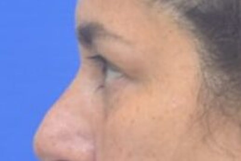Blepharoplasty Before & After Gallery - Patient 128736 - Image 7