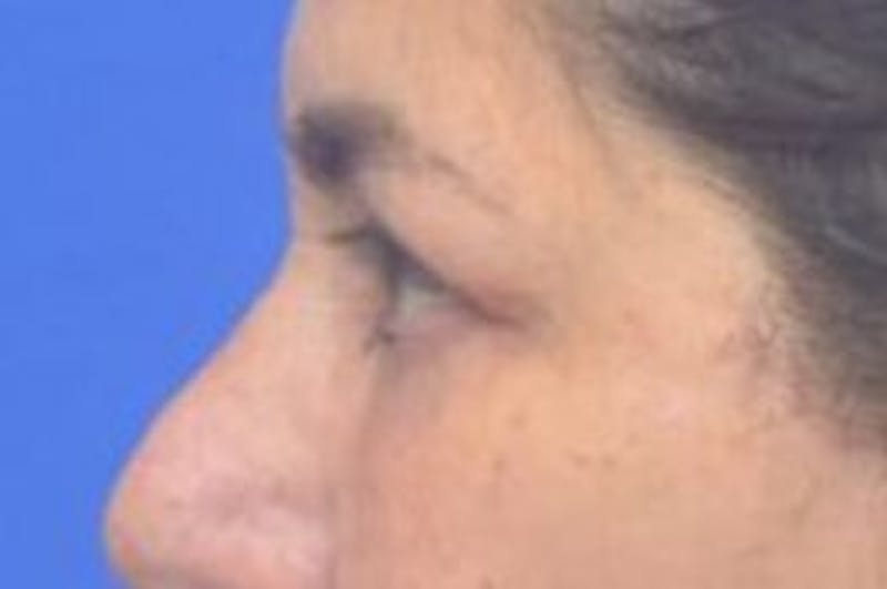 Blepharoplasty Before & After Gallery - Patient 128736 - Image 8