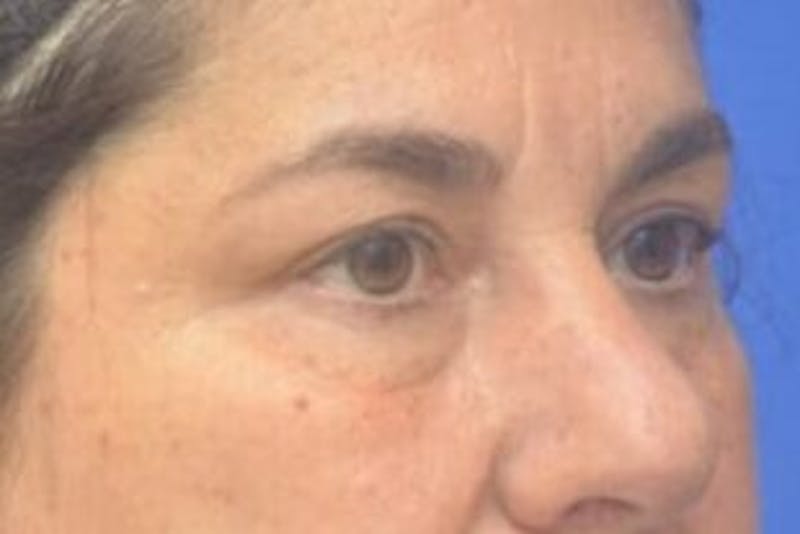 Blepharoplasty Before & After Gallery - Patient 128736 - Image 9