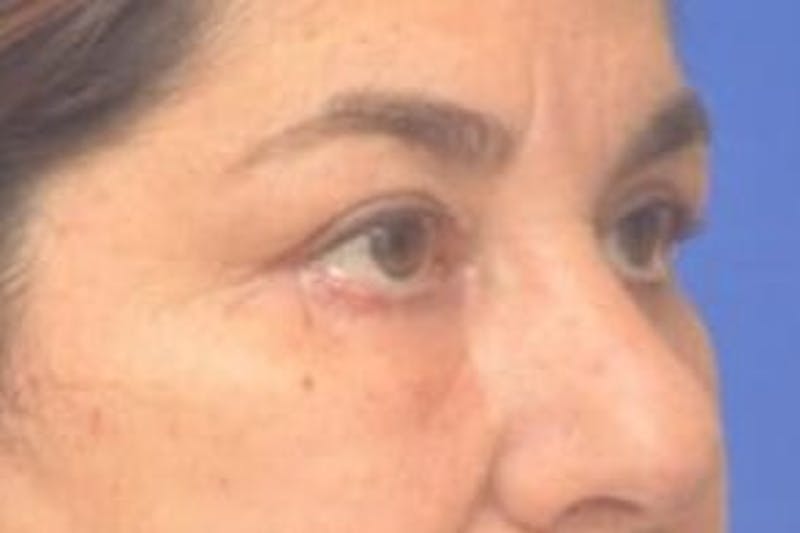 Blepharoplasty Before & After Gallery - Patient 128736 - Image 10