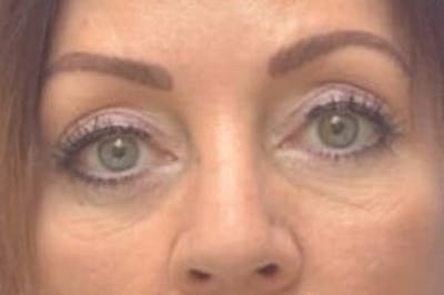 Blepharoplasty Before & After Gallery - Patient 203817 - Image 1