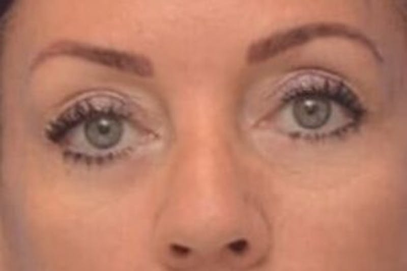 Blepharoplasty Before & After Gallery - Patient 203817 - Image 2
