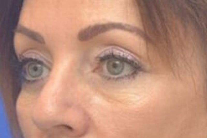 Blepharoplasty Before & After Gallery - Patient 203817 - Image 3