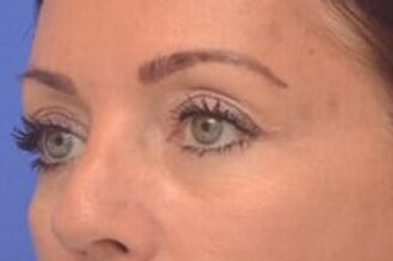 Blepharoplasty Before & After Gallery - Patient 203817 - Image 4