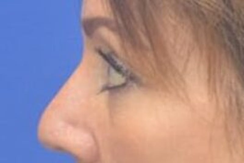 Blepharoplasty Before & After Gallery - Patient 203817 - Image 5