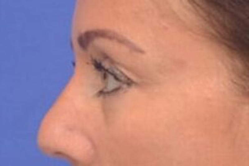 Blepharoplasty Before & After Gallery - Patient 203817 - Image 6
