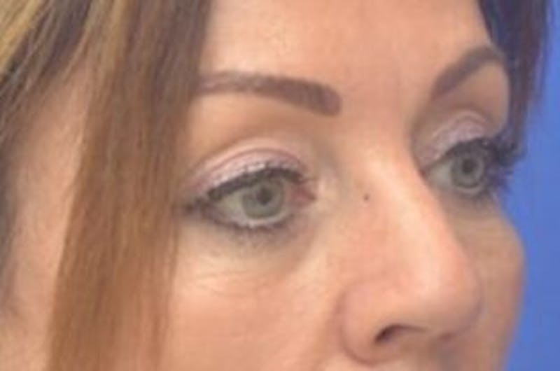 Blepharoplasty Before & After Gallery - Patient 203817 - Image 7