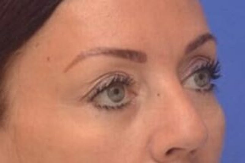 Blepharoplasty Before & After Gallery - Patient 203817 - Image 8