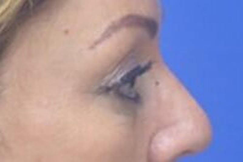 Blepharoplasty Before & After Gallery - Patient 203817 - Image 9