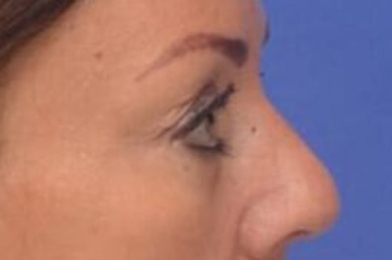 Blepharoplasty Before & After Gallery - Patient 203817 - Image 10