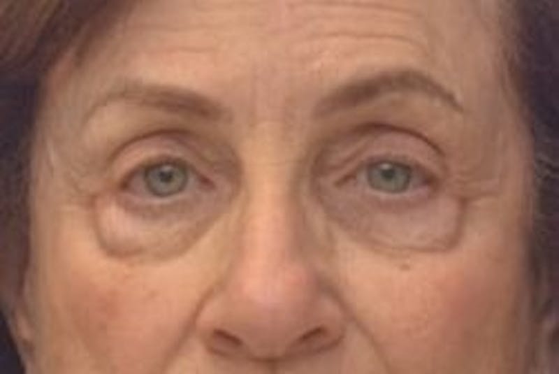 Blepharoplasty Before & After Gallery - Patient 365911 - Image 1