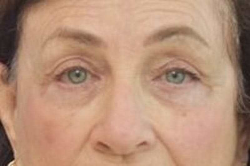 Blepharoplasty Before & After Gallery - Patient 365911 - Image 2