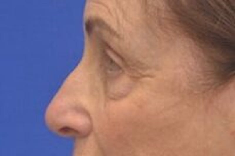Blepharoplasty Before & After Gallery - Patient 365911 - Image 3