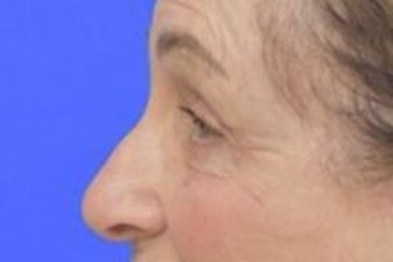 Blepharoplasty Before & After Gallery - Patient 365911 - Image 4