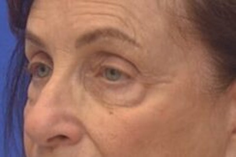 Blepharoplasty Before & After Gallery - Patient 365911 - Image 5