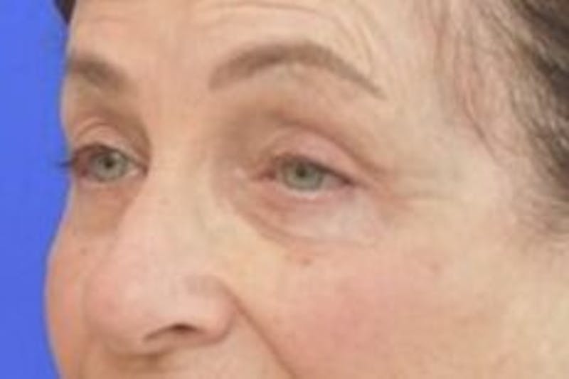 Blepharoplasty Before & After Gallery - Patient 365911 - Image 6