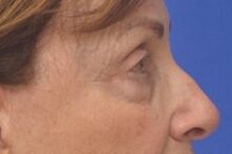 Blepharoplasty Before & After Gallery - Patient 365911 - Image 7