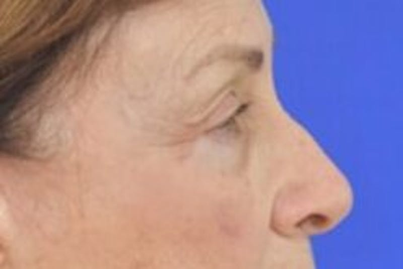 Blepharoplasty Before & After Gallery - Patient 365911 - Image 8