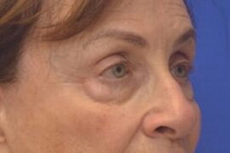 Blepharoplasty Before & After Gallery - Patient 365911 - Image 9