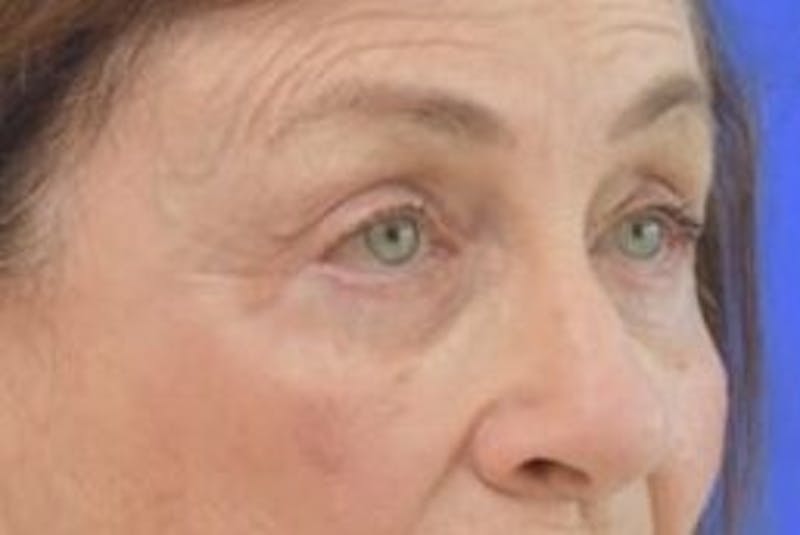 Blepharoplasty Before & After Gallery - Patient 365911 - Image 10