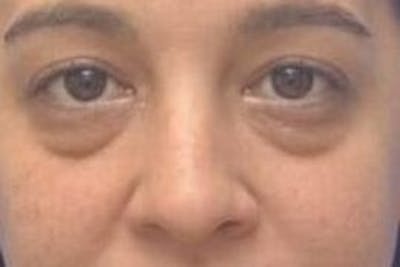 Blepharoplasty Before & After Gallery - Patient 408268 - Image 1