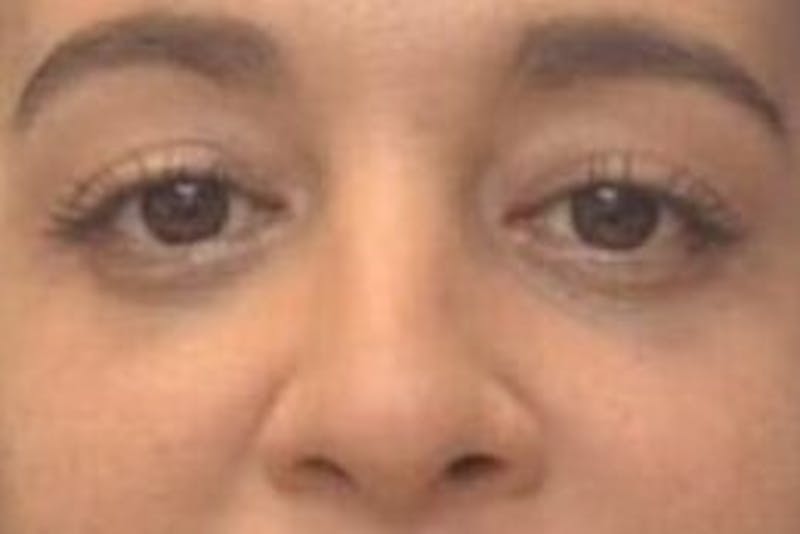 Blepharoplasty Before & After Gallery - Patient 408268 - Image 2