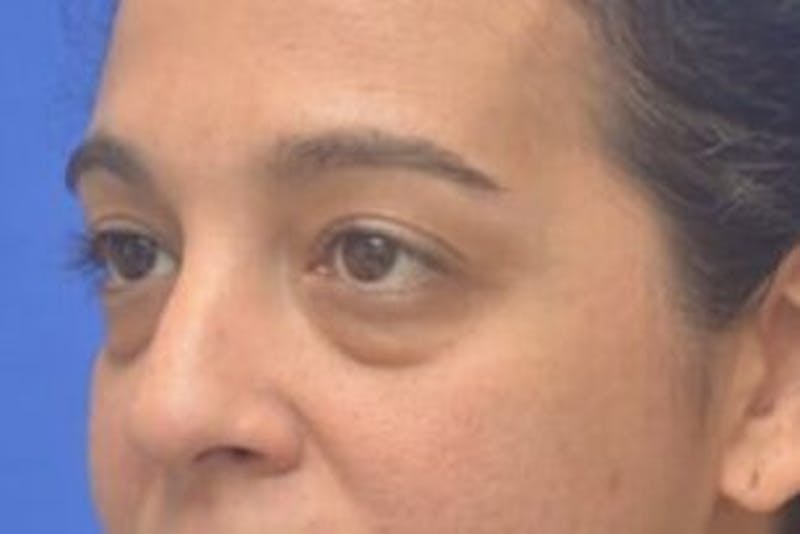 Blepharoplasty Before & After Gallery - Patient 408268 - Image 3