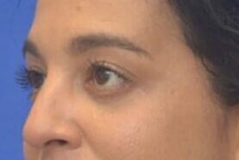 Blepharoplasty Before & After Gallery - Patient 408268 - Image 4