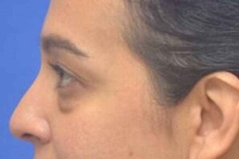Blepharoplasty Before & After Gallery - Patient 408268 - Image 5
